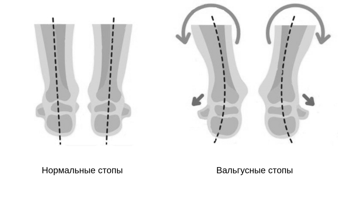 Вальгус у детей